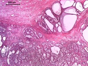 histopatologiczny-obraz-ziarniszczaka-jajnika-u-klaczy-2