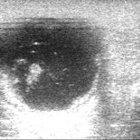 przetrwaly-nieewoulujacy-pecherzyk-jajnikowy-poczatek-luteinizacji