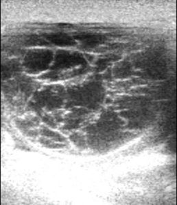 przetrwaly-nieowulujacy-pecherzyk-jajnikowy-zaawansowana-luteinizacja